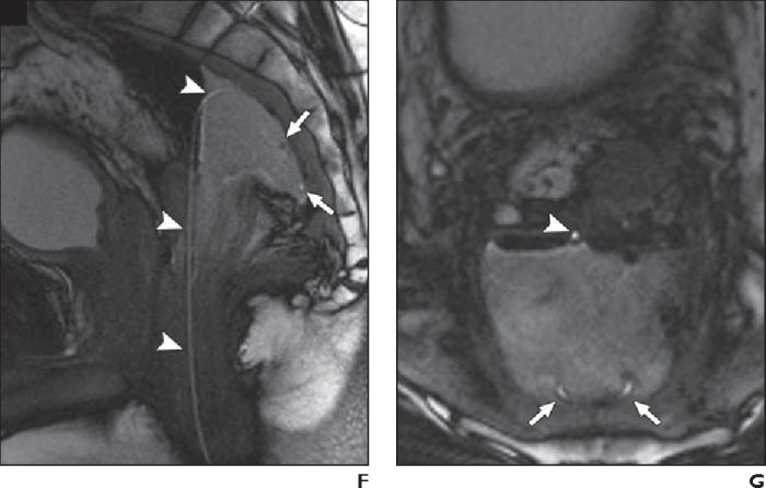 Transrectal drainage of pelvic abscess cpt code