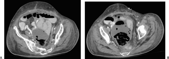 Transrectal drainage of pelvic abscess cpt code