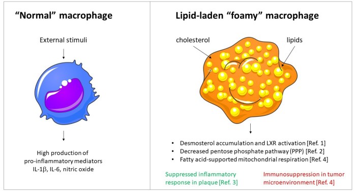 Foamy macrophages and fat globules breast