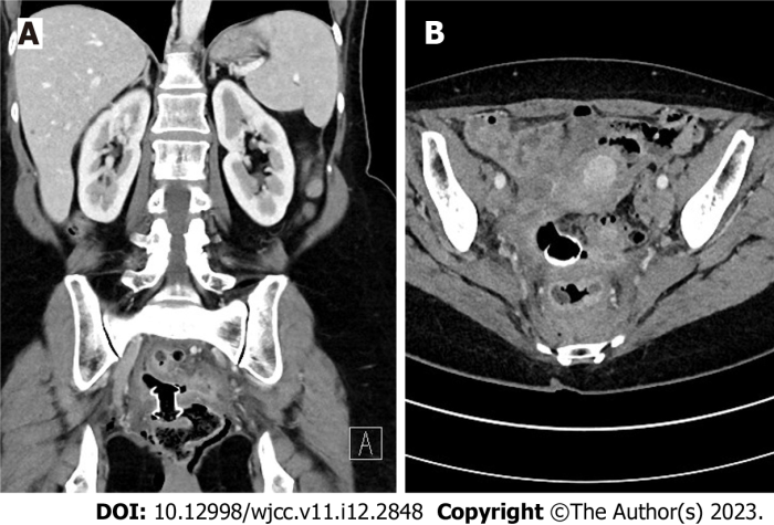 Transrectal drainage of pelvic abscess cpt code