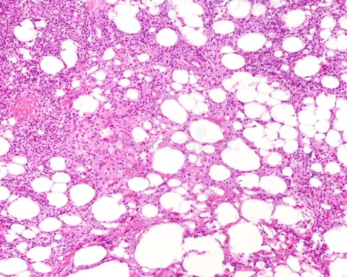 Foamy macrophages and fat globules breast